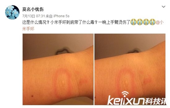 小米手環燙傷用戶？ 真假難辨誰之過